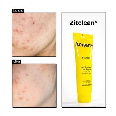 Очищуючий гель із саліциловою кислотою для проблемної шкіри Acnemy ZITCLEAN 150ml, 150ml